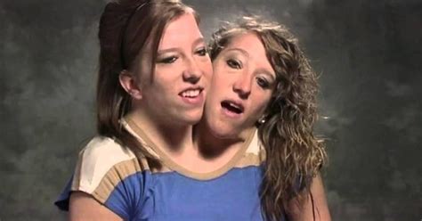 nude conjoined twins|real conjoined twins Search